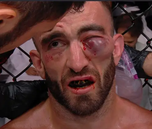 Mohammad Yahya terminó con el ojo seriamente lastimado tras su pelea en UFC Abu Dhabi. @UFC Mohammad Yahya terminó con el ojo seriamente lastimado tras su pelea en UFC Abu Dhabi. @UFC