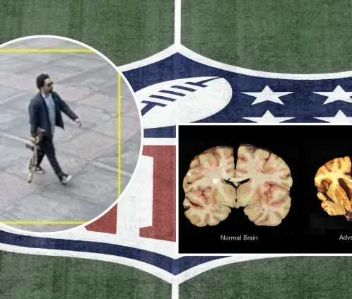 La ETC ha sido una de las enfermedades que más revuelo han causado a raíz de su descubrimiento en ex jugadores de la NFL. La ETC ha sido una de las enfermedades que más revuelo han causado a raíz de su descubrimiento en ex jugadores de la NFL.
